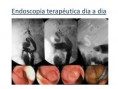 /album/ubicacion-aberrante-de-papila/asenda-papila-bulboduodenal-1-11-jpg/